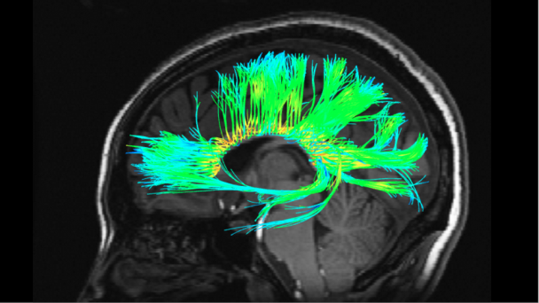 Diffusion Tensor Imaging (DTI